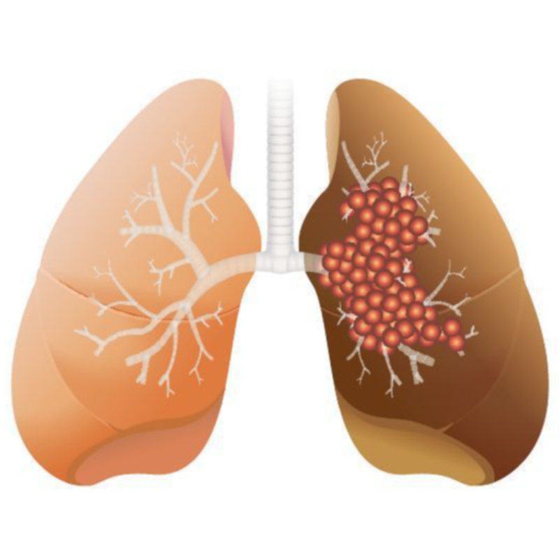 Une dose élevée de NMN inhibe la croissance de l\'adénocarcinome pulmonaire